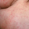 Measles on back / visualdx
